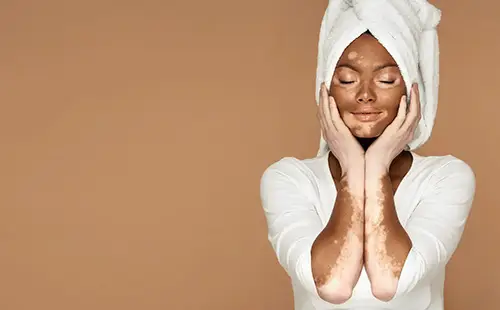 o que é o vitiligo